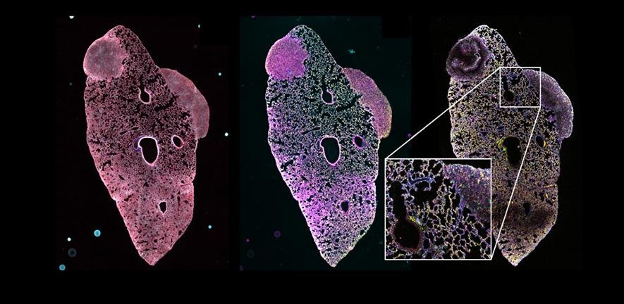 Lung with two metastatic lesions derived from a mouse primary triple-negative breast tumour